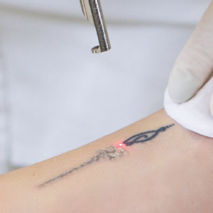 Pielis sitio web_RESURLASER SCAR REPAIR Cicatriz por tatuajes