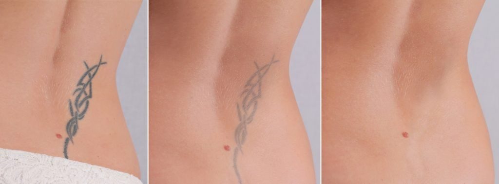Qué es la eliminación de tatuajes con láser? - Pielis Institute